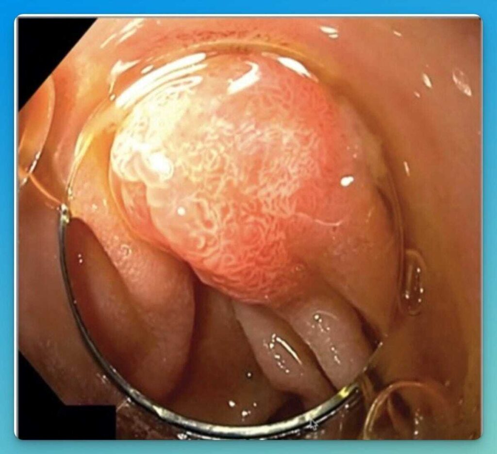Caps In Gi Endoscopy