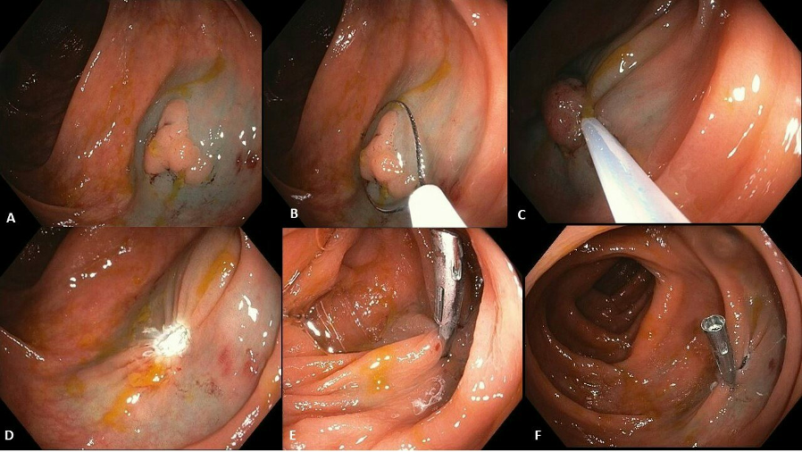 Endoscopic Resection Of Lst In Ascending Colon