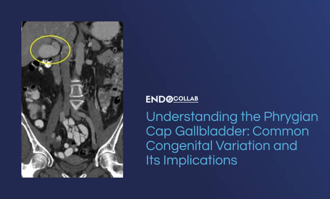 Understanding the Phrygian Cap Gallbladder: Common Congenital Variation ...