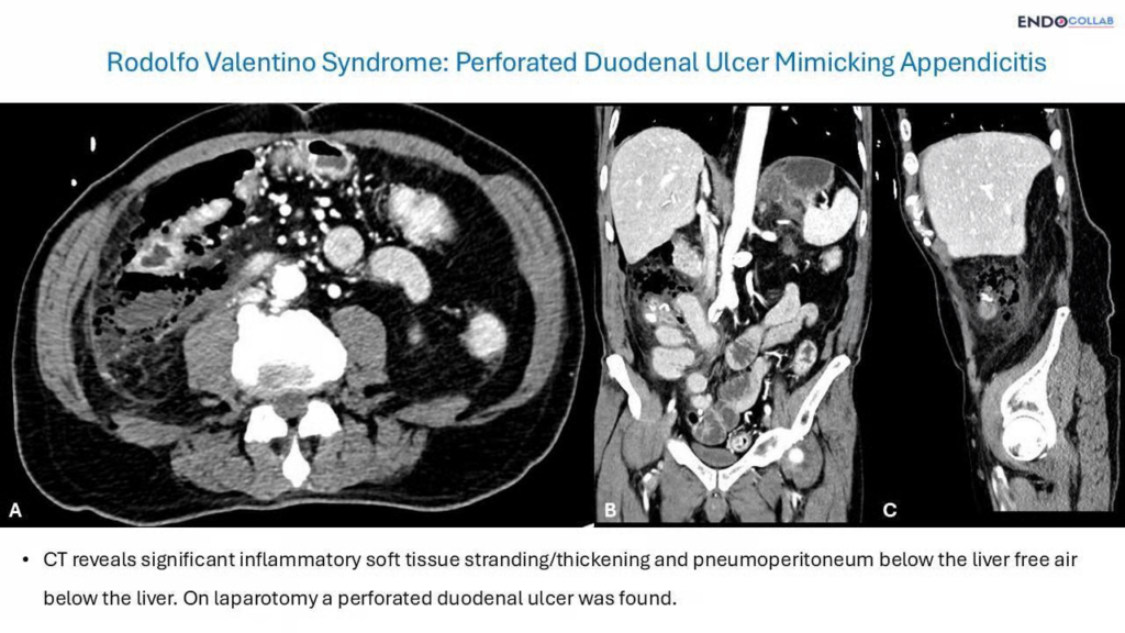 Rodolfo Valentino Syndrome: Perforated Duodenal Ulcer Mimicking Appendicitis