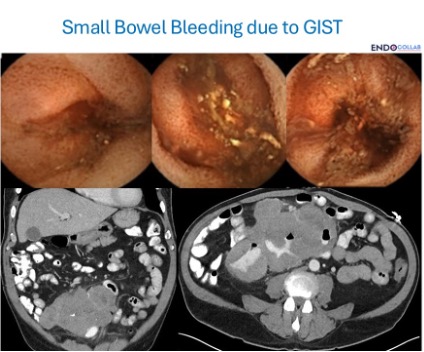 Small Bowel Bleeding Due To Gist 2 Capsule Endoscopy And Ct Images Showing Small Bowel Gist