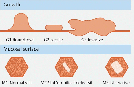 Small Bowel Bleeding Due To Gist 3 Classification Of Small Bowel Gist