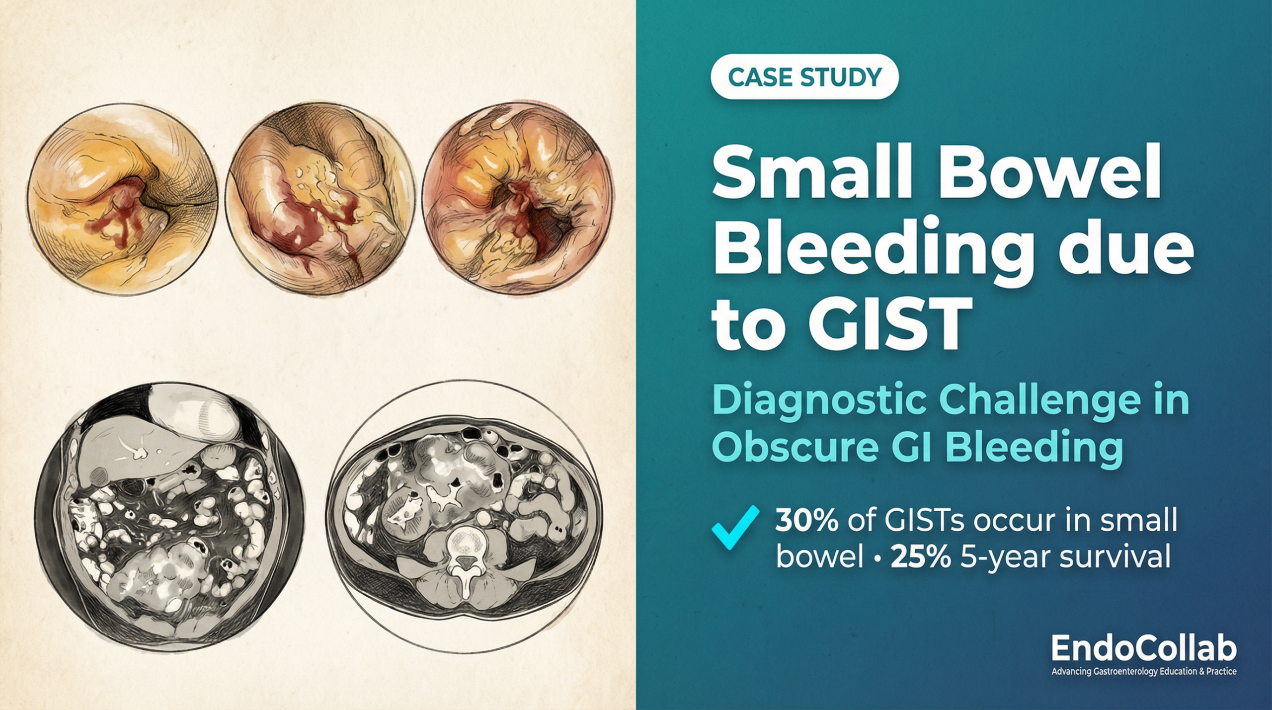 Meta Description (148 Characters): Diagnosing Small Bowel Gist Is A Challenge. See Capsule Endoscopy And Ct Images Of This Rare Cause Of Obscure Gi Bleeding With A 25% 5-Year Survival Rate.