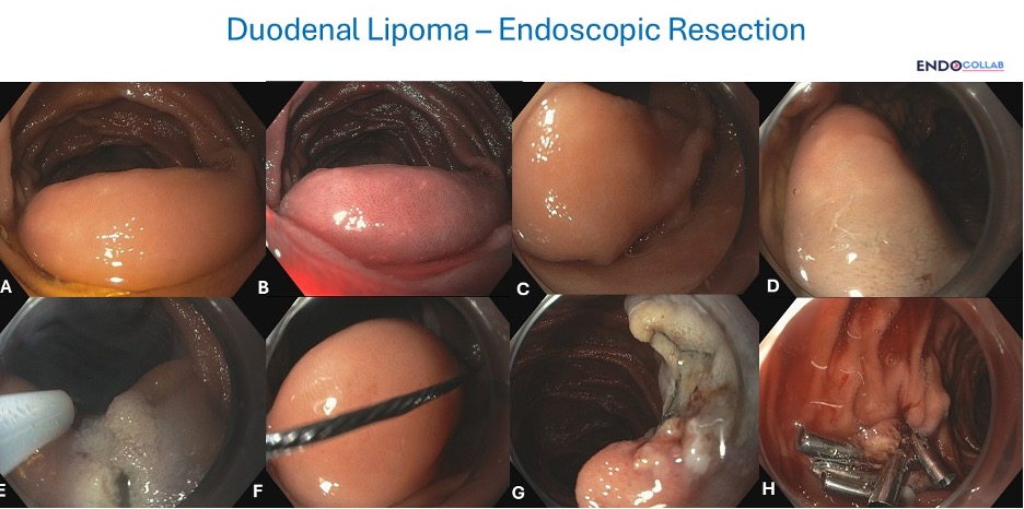 Endoscopic Resection Of Large Duodenal Lipoma
