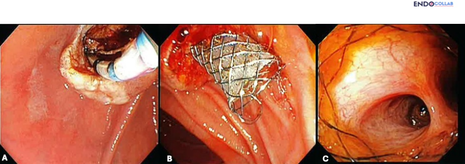 Technical Tips And Tricks In Ercp: Fully Covered Metallic Stent-Assisted Direct Cholangioscopy