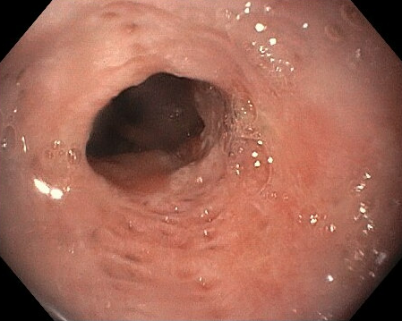 Esophageal Intramural Pseudodiverticulosis (Eip)