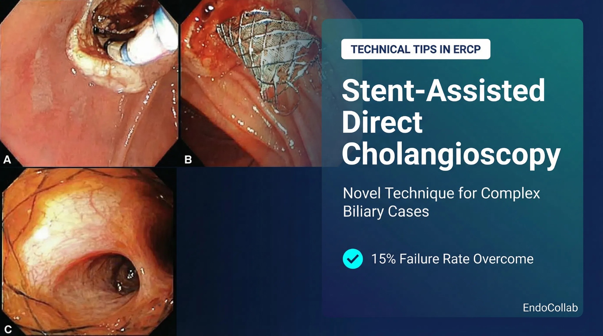 Technical Tips And Tricks In Ercp: Fully Covered Metallic Stent-Assisted Direct Cholangioscopy