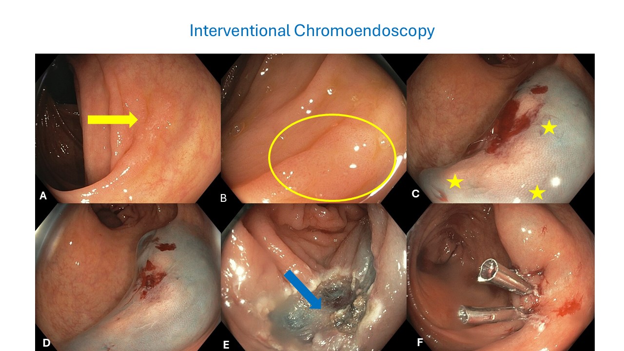 Gi Endoscopy Community &Amp; Education - Endocollab