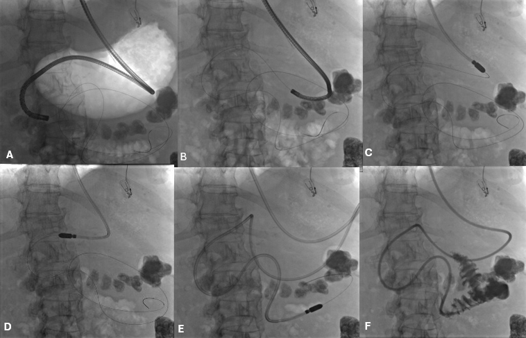Endoscopic-Fluoroscopic Nasojejunal Feeding Tube Placement Using A Long Biliary Guidewire: A Step-By-Step Technique