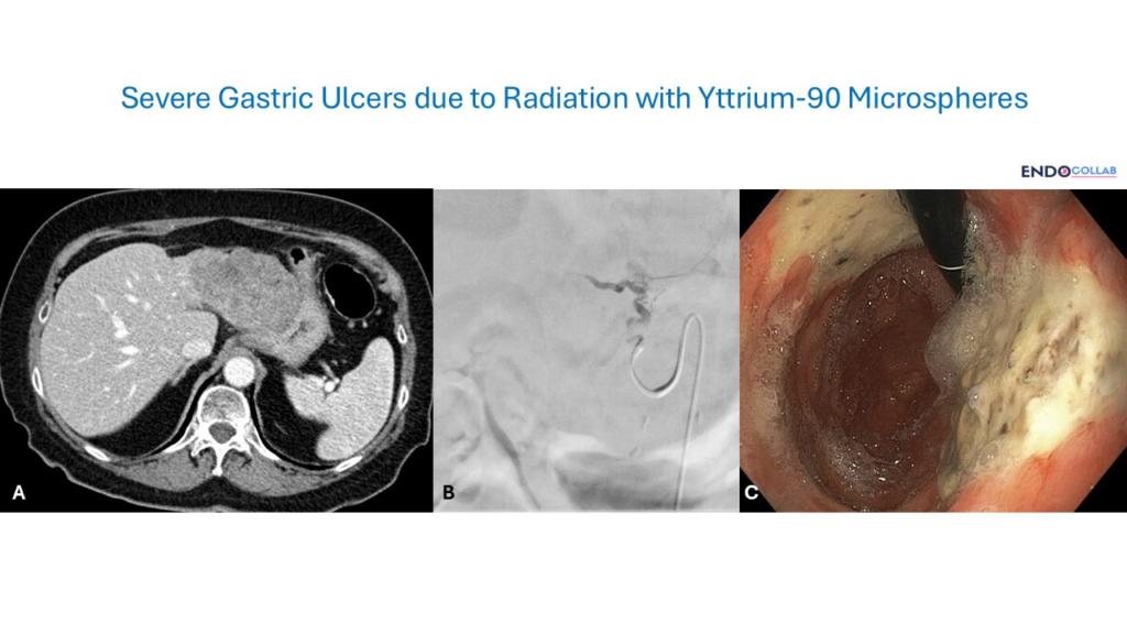 Severe Gastric Ulcers Due To Radiation With Yttrium-90 Microspheres