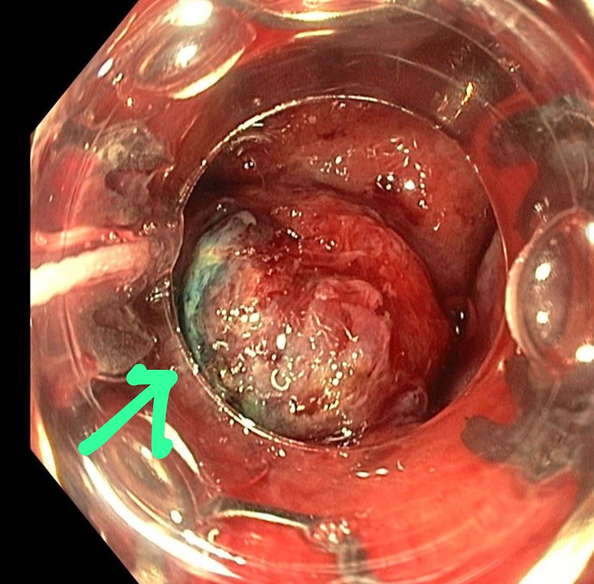 Duodenal Net After Hybrid Emr Attempt Showing Firm Tumor Adjacent To Pylorus