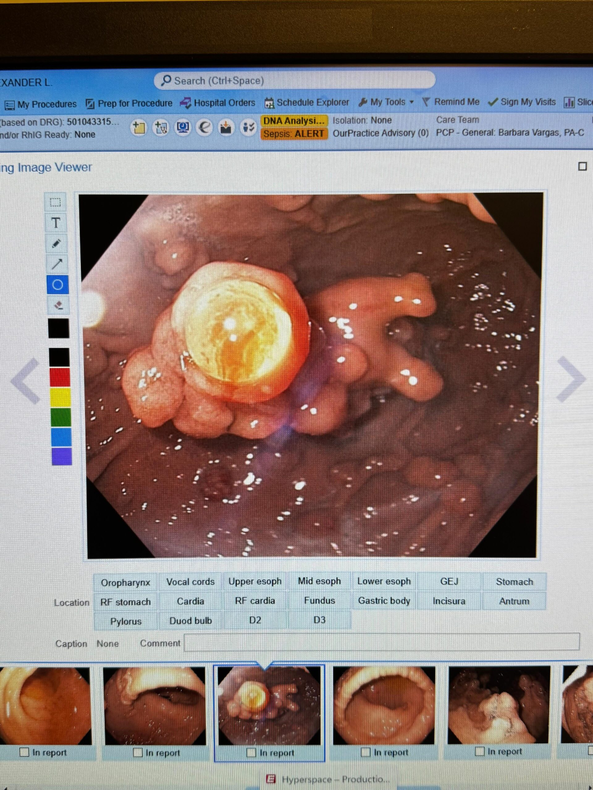 Gastric Polyposis Endoscopic View Showing Polyps Carpeting The Body, Cardia, And Fundus With Spared Antrum