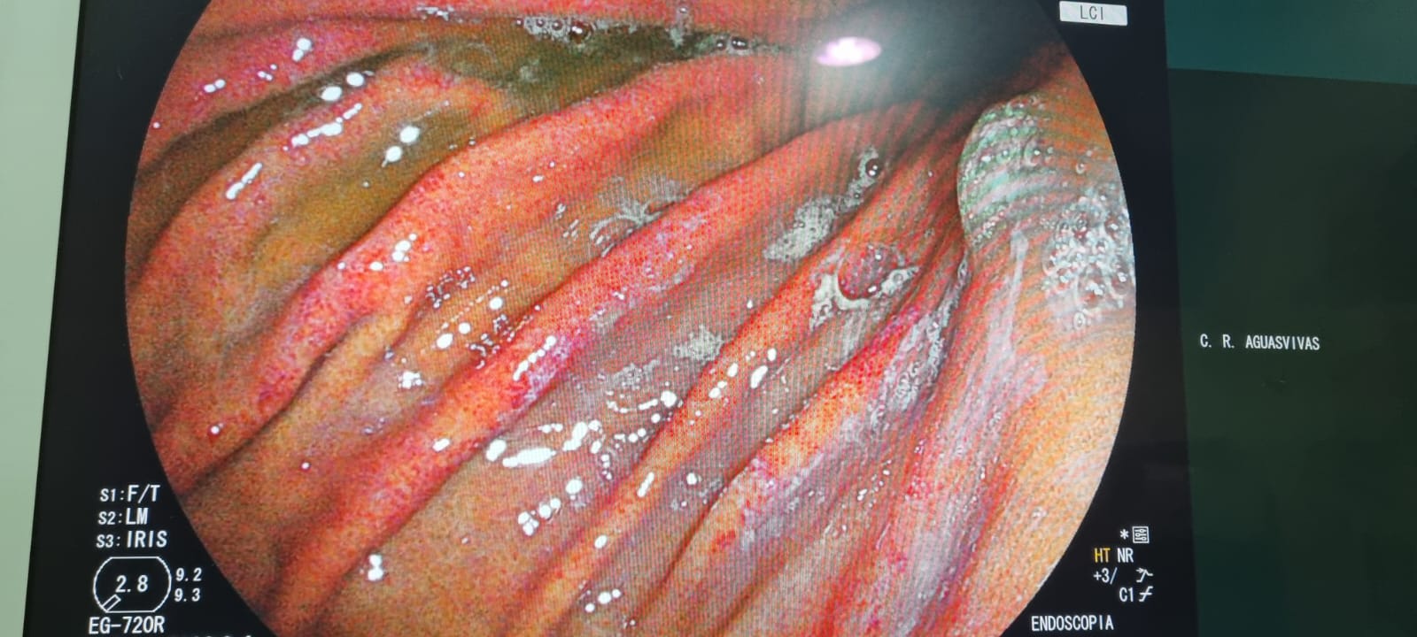 Gastric Body With Serpentine Mucosal Pattern And Whitish Areas In Alcoholic Patient