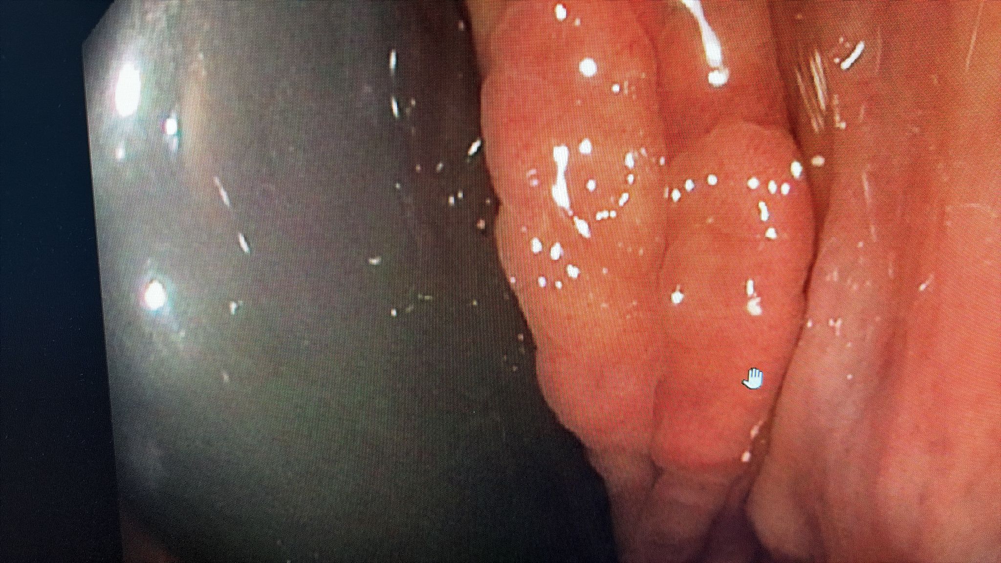 Rectal Lesion With Uncertain Endoscopic Appearance, Possible Ectopic Gastric Mucosa