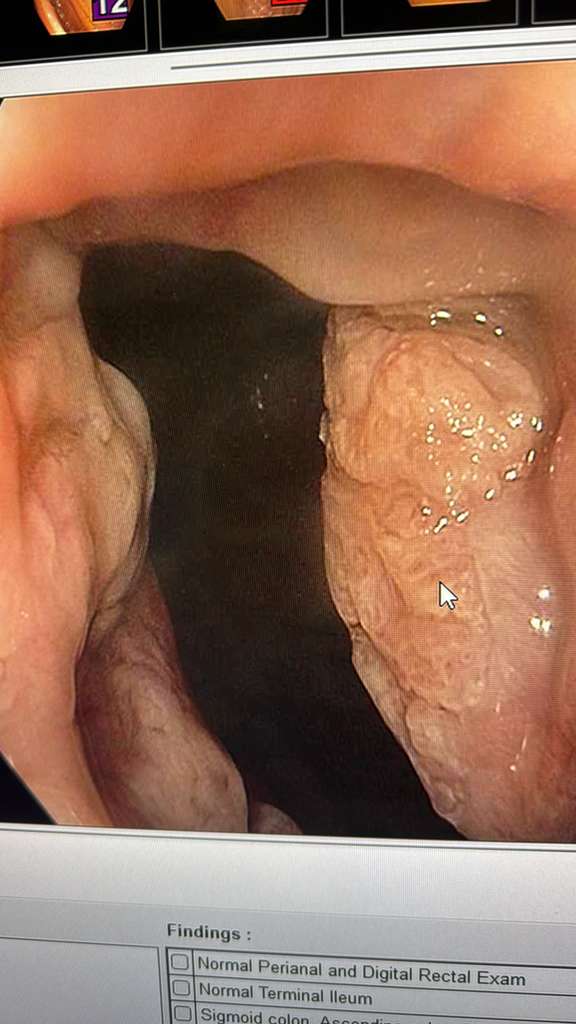 Internal Hemorrhoids With White Anal Mucosal Changes