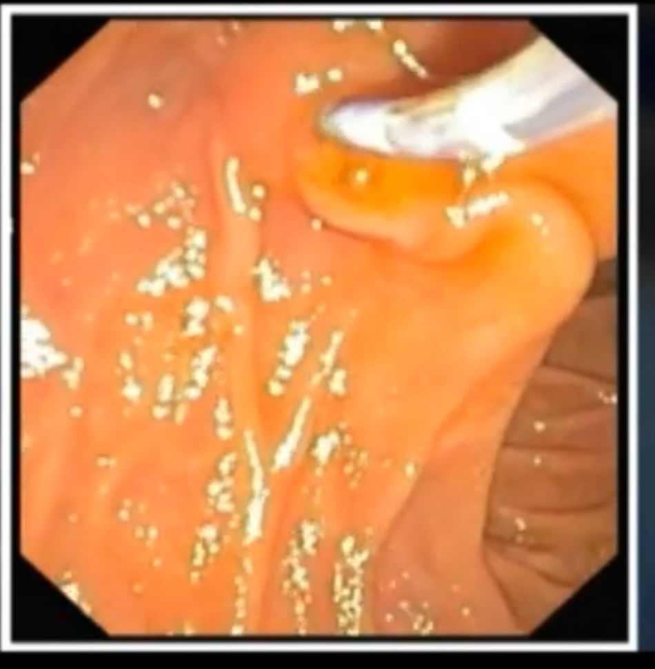 Papilla Orientation During Ercp Cannulation Showing Proper Positioning Approach