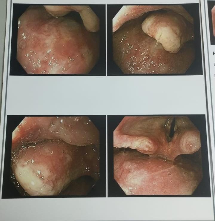 Oropharyngeal Ulcerated Lesions At Tongue Base, Epiglottis, And Aryepiglottic Folds