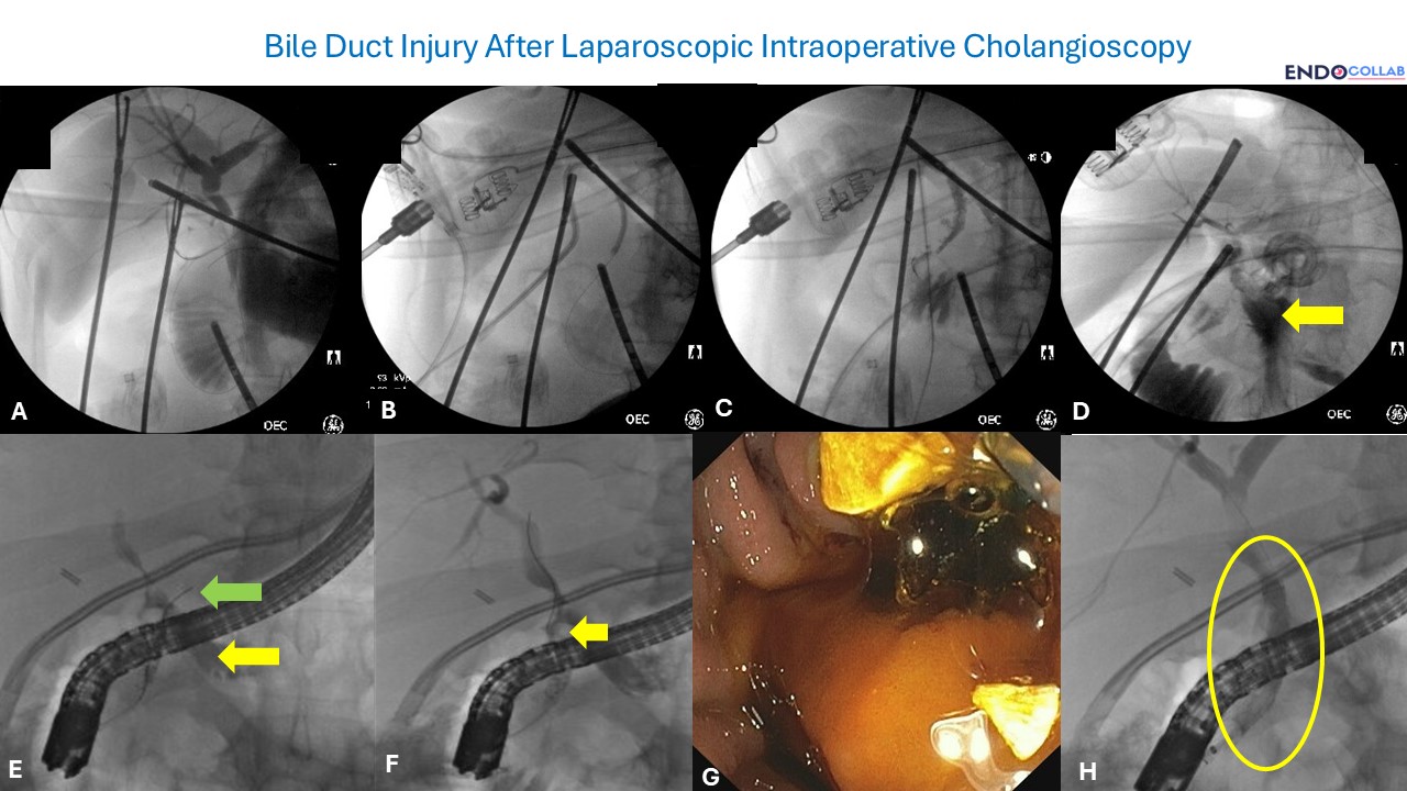8-Panel Composite Showing Intraoperative Cholangiogram With Bile Duct Stones (A), Cholangioscopic View Of Impacted Stones (B-C), Bile Leak On Cholangiogram (D), Ercp Demonstrating Bile Leak With Wire Exiting Injury (E), Filling Defect And Wire Placement (F), Self-Expanding Metal Stent Deployment (G), And Occlusion Cholangiogram Confirming Leak Resolution (H)