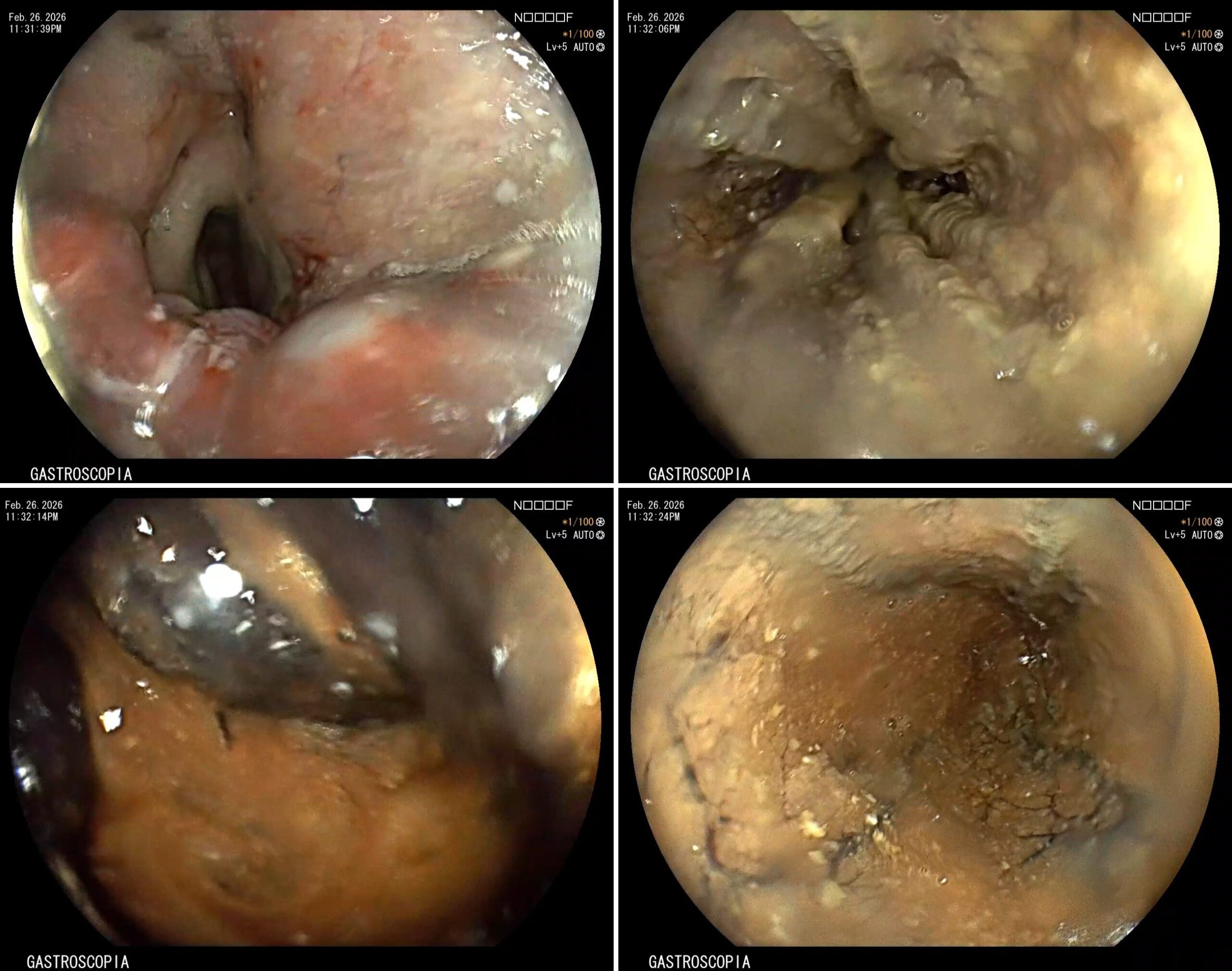 Gi Endoscopy Community &Amp; Education - Endocollab