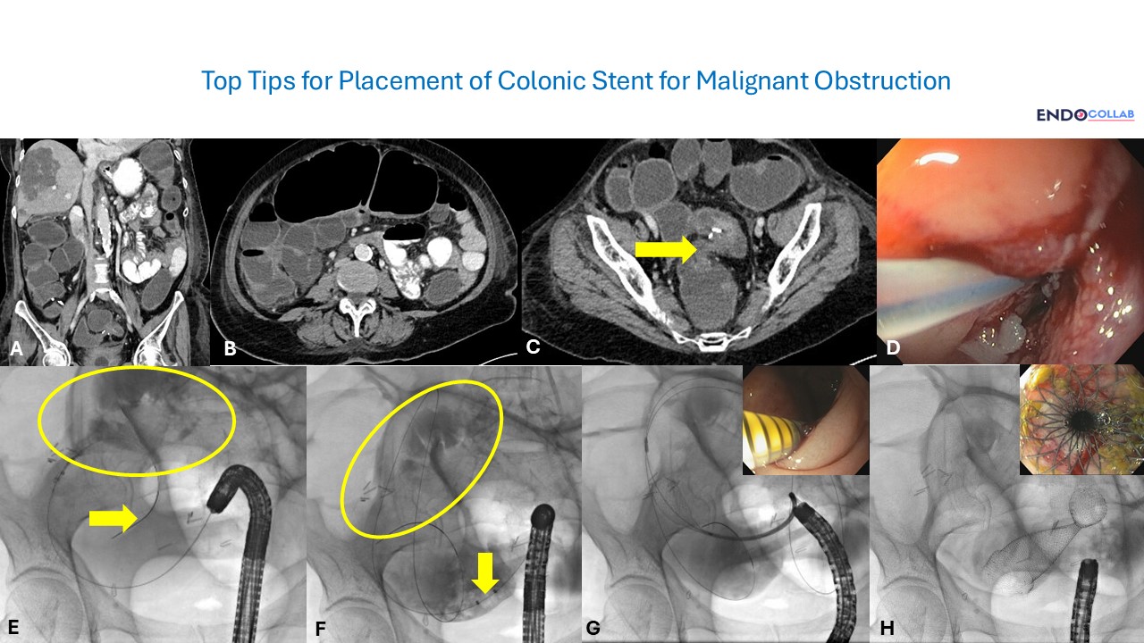 Gi Endoscopy Community &Amp; Education - Endocollab