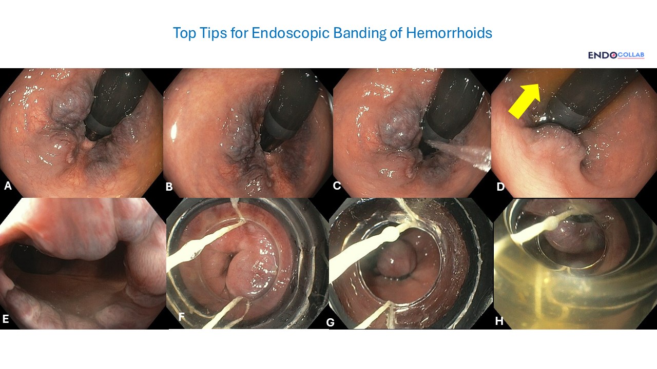 Gi Endoscopy Community &Amp; Education - Endocollab
