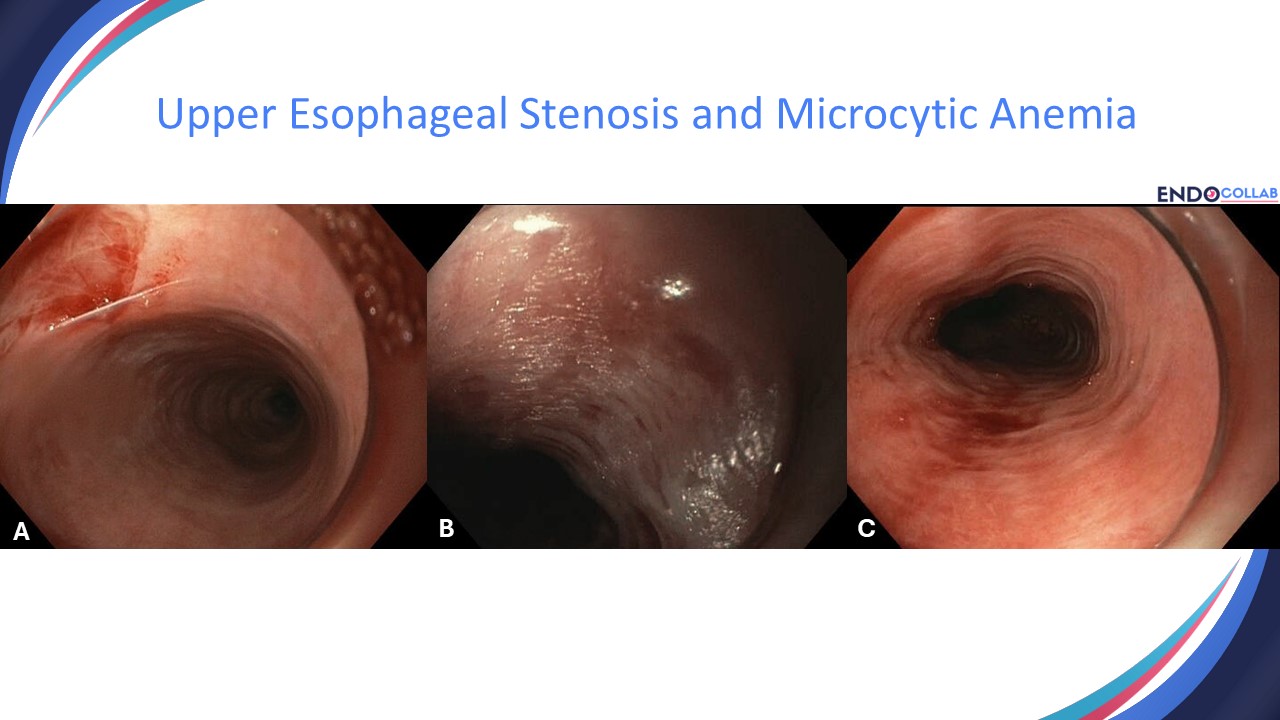 Gi Endoscopy Community &Amp; Education - Endocollab