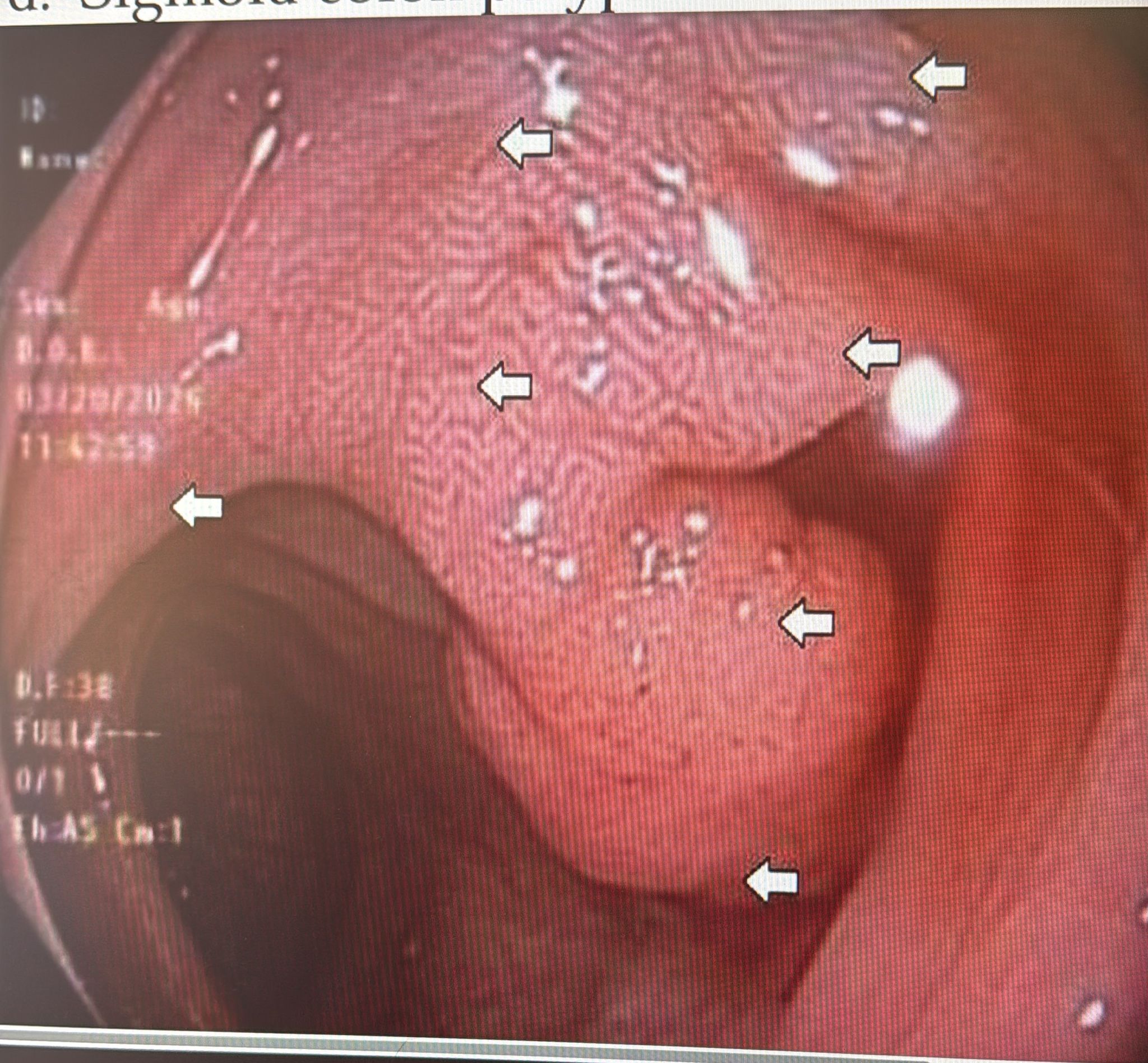 Chicken Skin Mucosa At The Base Of A Pedunculated Polyp, Colonoscopy View