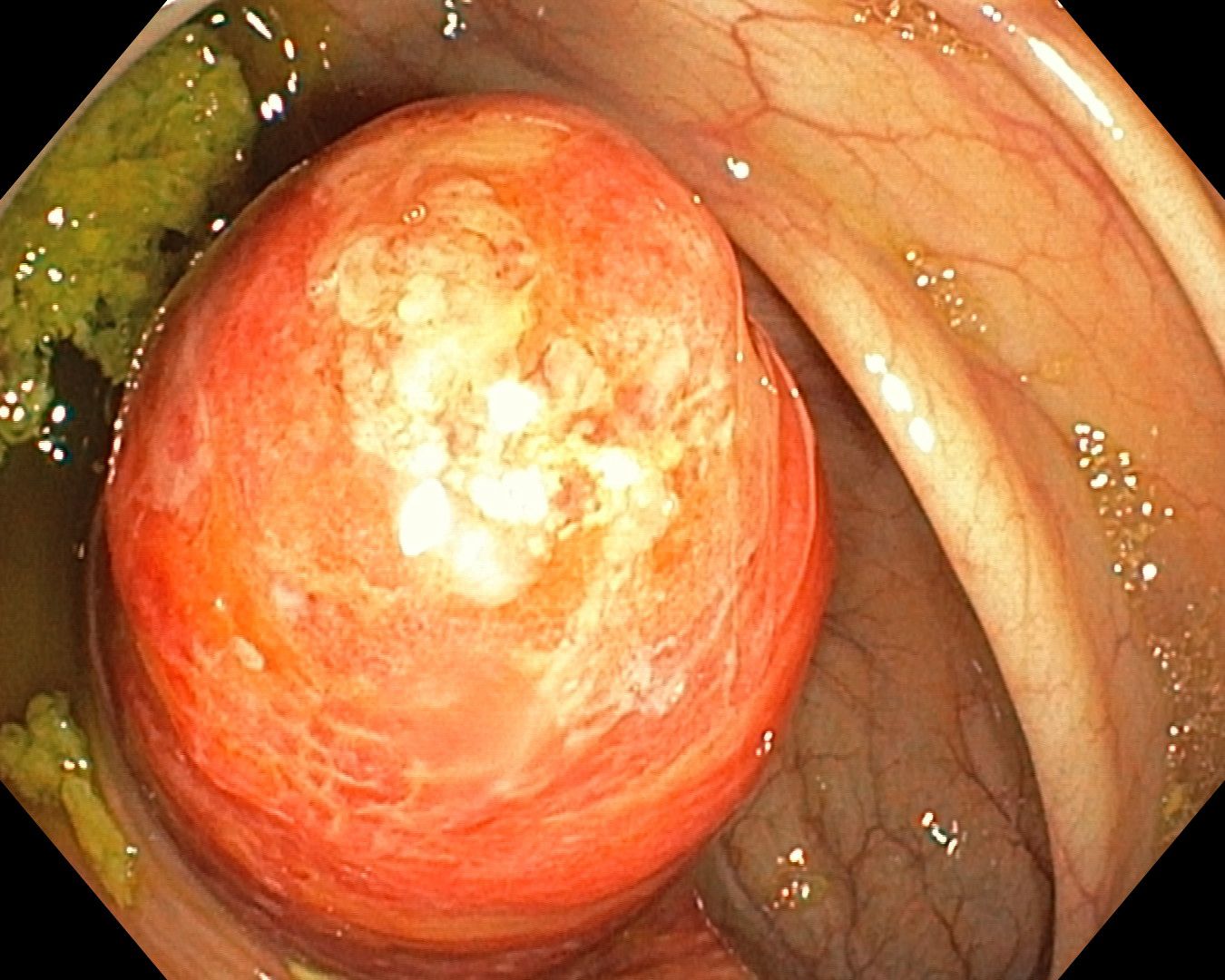 Inverted Appendix Appendicitis On Colonoscopy, Second Projection