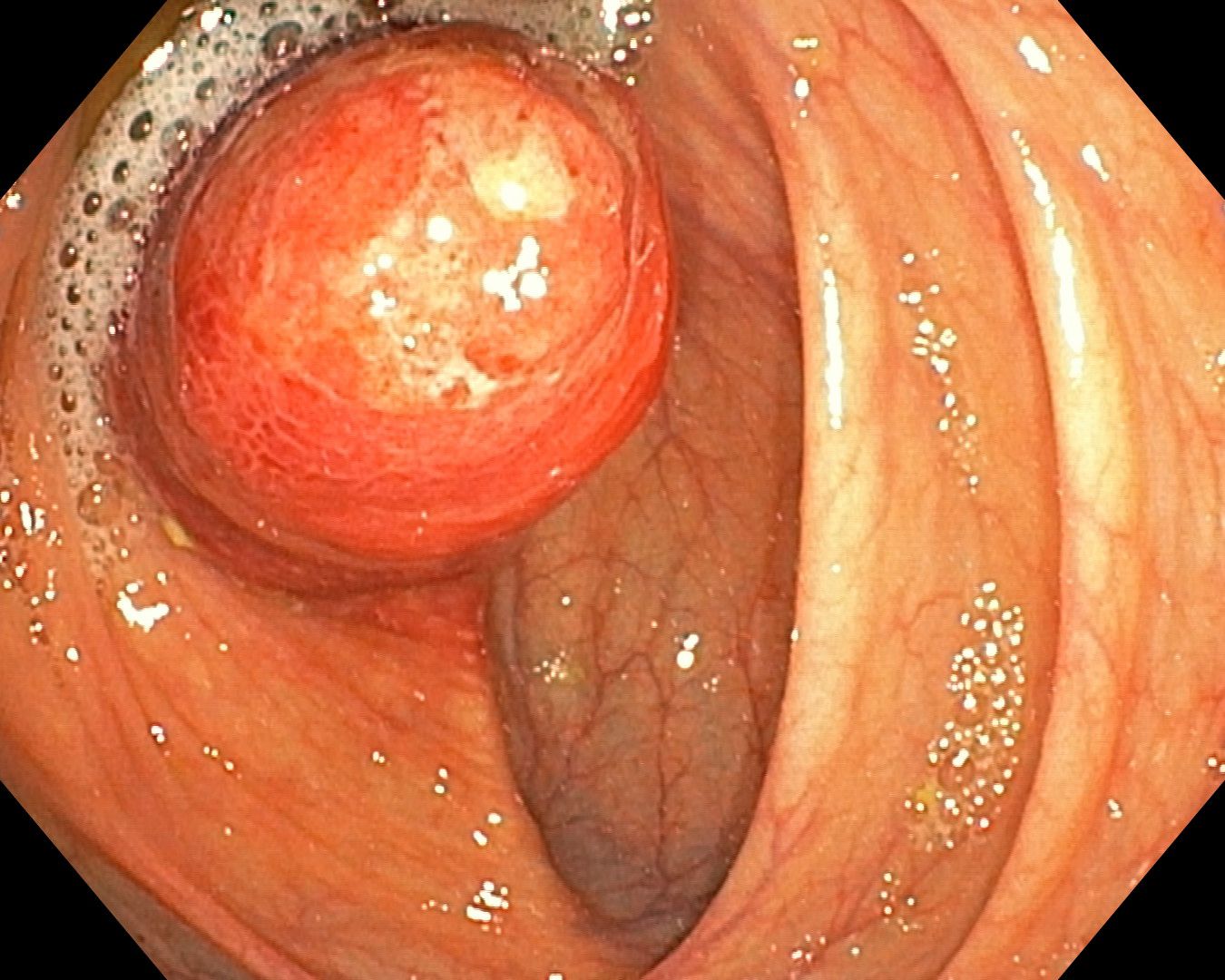 Inverted Appendix Appendicitis On Colonoscopy, Closer View Of The Base