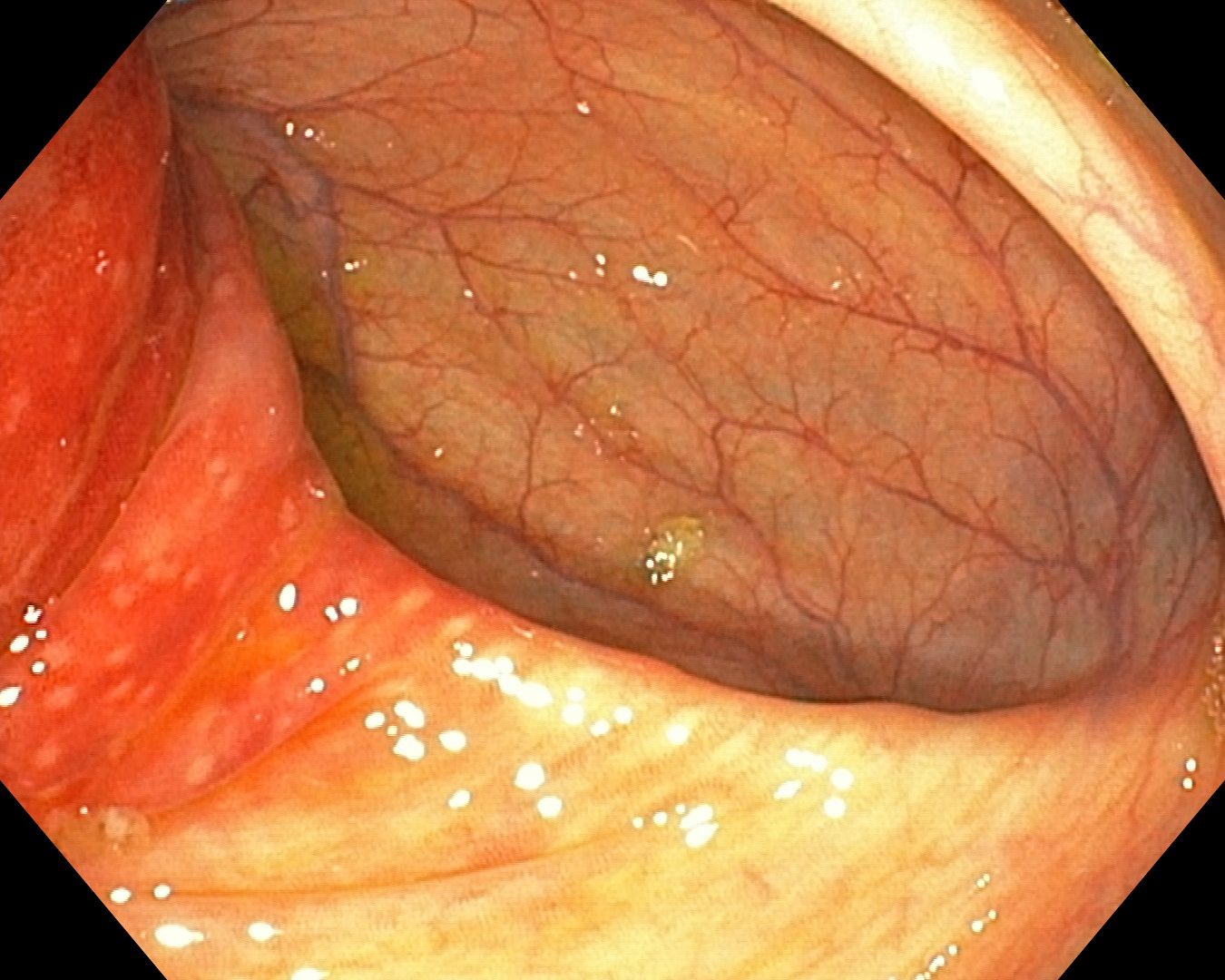 Inverted Appendix Appendicitis On Colonoscopy, Mucosal Detail