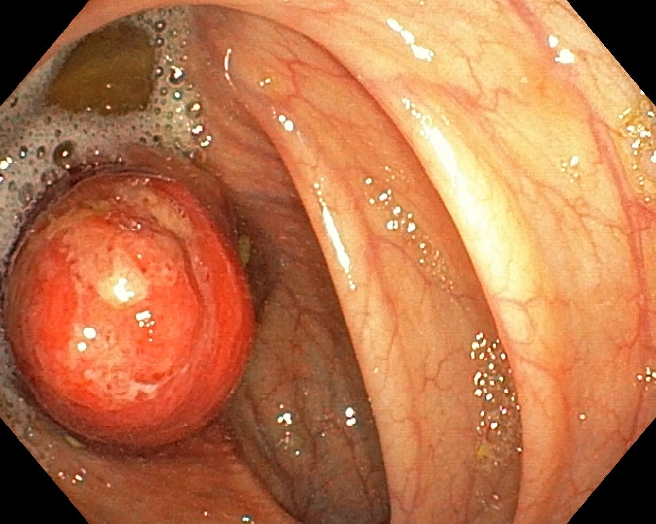 Inverted Appendix Appendicitis On Colonoscopy, Final View