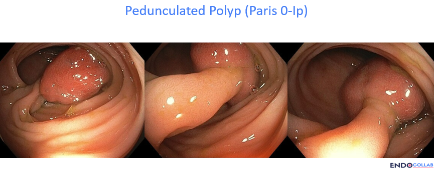 Gi Endoscopy Community &Amp; Education - Endocollab