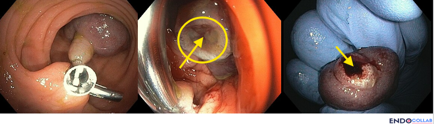 How Would You Remove This Pedunculated Polyp (Paris 0-Ip, Kudo Iiil)? 2 Three-Panel Endoscopic Composite Showing The Technique Sequence: Prophylactic Hemoclip On The Polyp Stalk Before Resection; The Post-Resection Stump With The Clipped Pedicle Highlighted By A Yellow Circle; And A Close-Up Of The Resected Specimen Pedicle Revealing A Large Feeding Vessel Marked With Yellow Arrows.