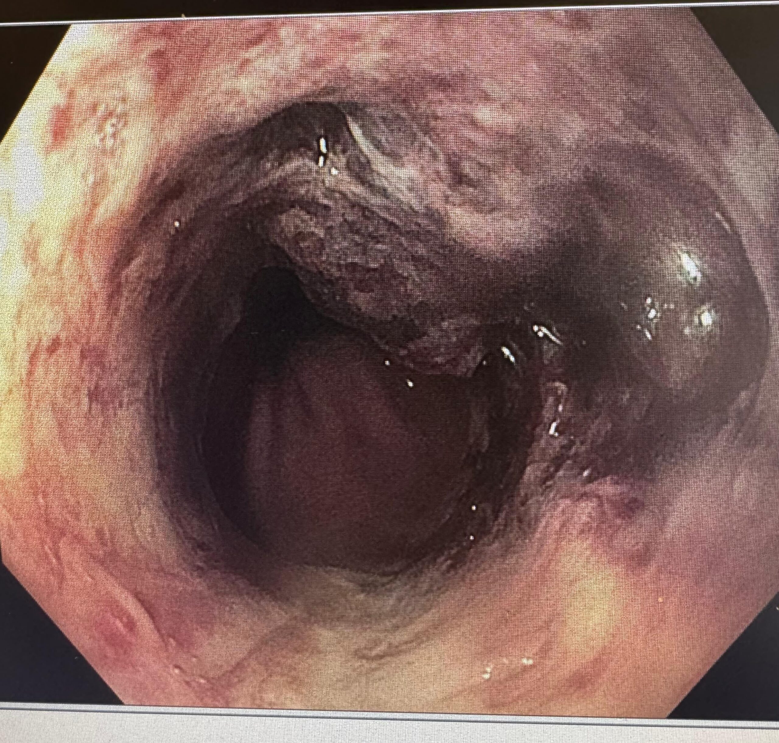 Black Esophagus Endoscopic View Showing Circumferential Dark Mucosal Necrosis