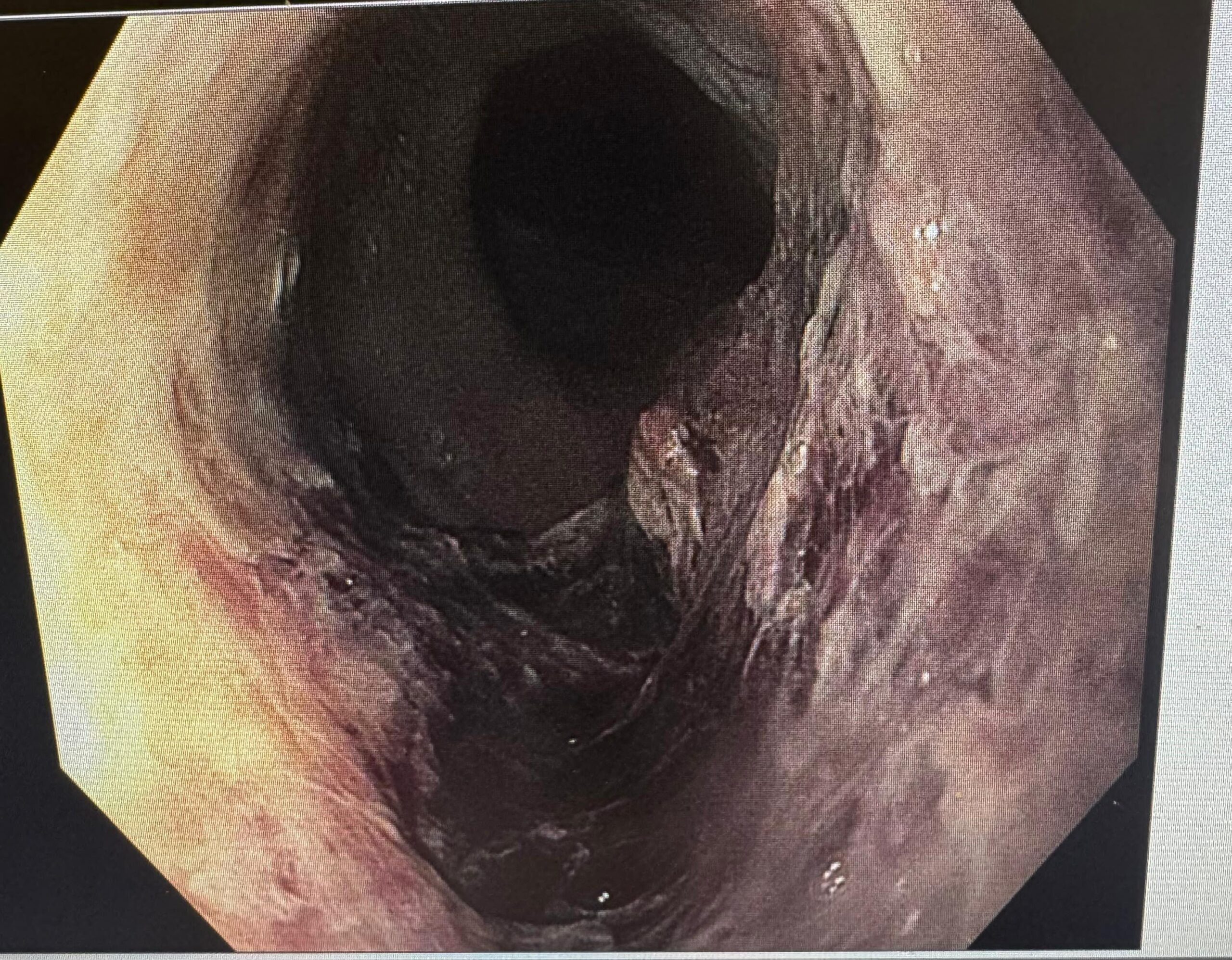 Black Esophagus With Overlying Clot After Hemospray Application