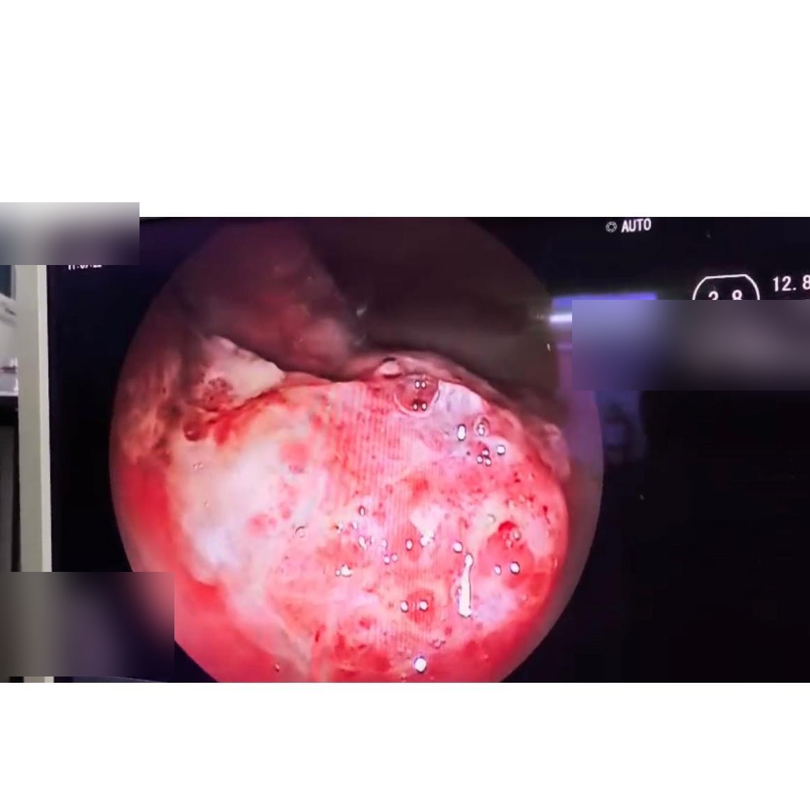 Ulcerated Polypoid Lesion In Distal Rectum In 34-Year-Old Female