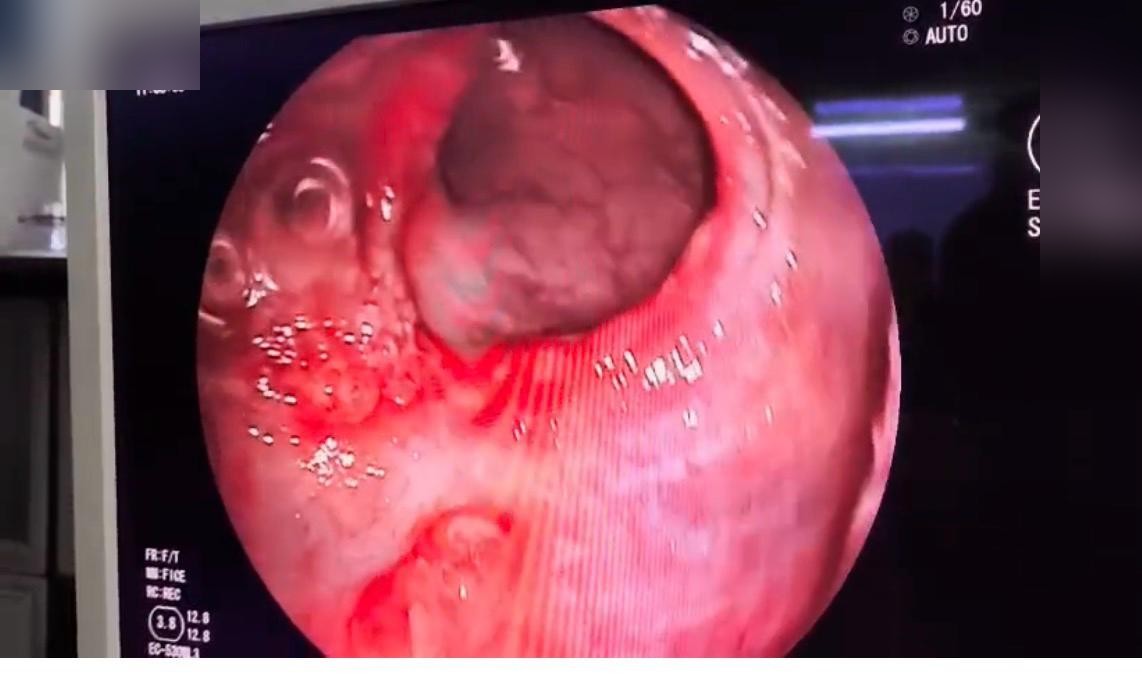 Rectal Erythema And Ulceration At First Rectal Fold Suggesting Srus