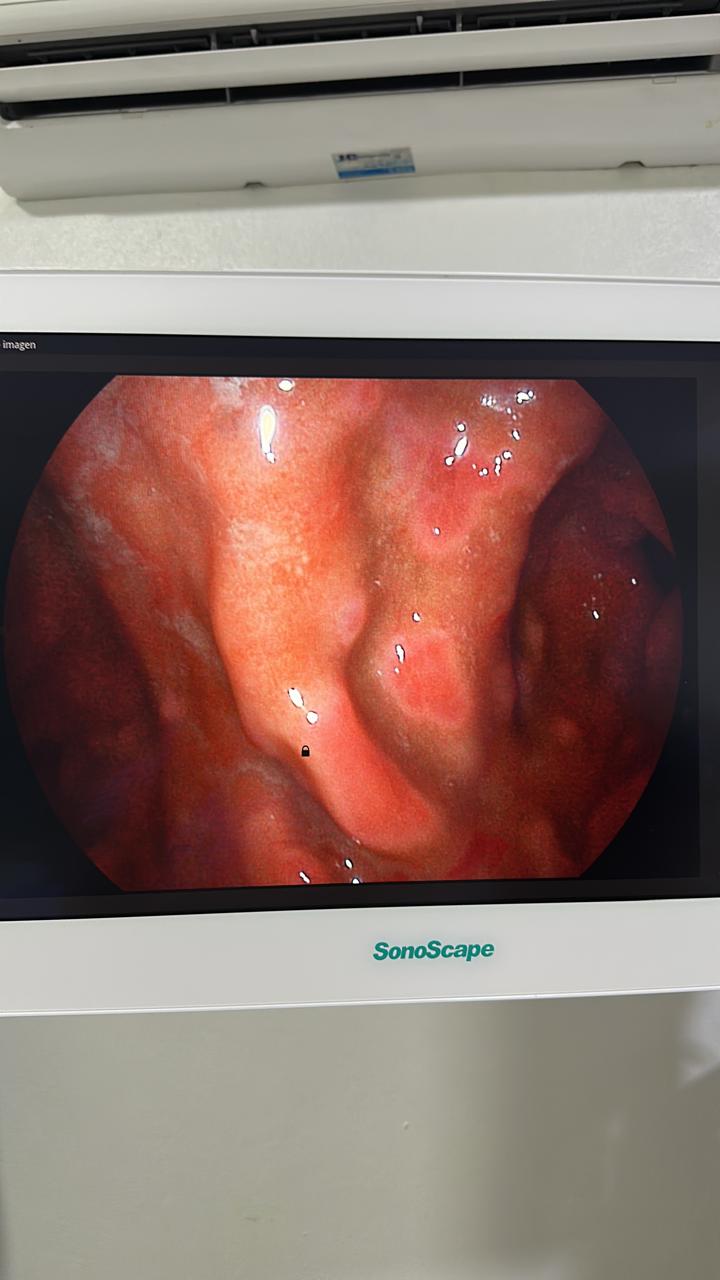 Gastric Mucosa With Patchy Erythema And Edema