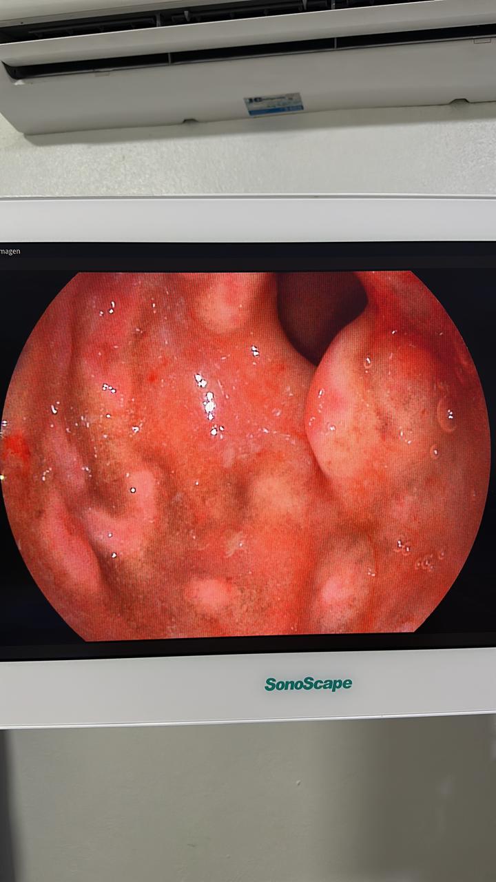 Gastric Findings Showing Loss Of Epithelium