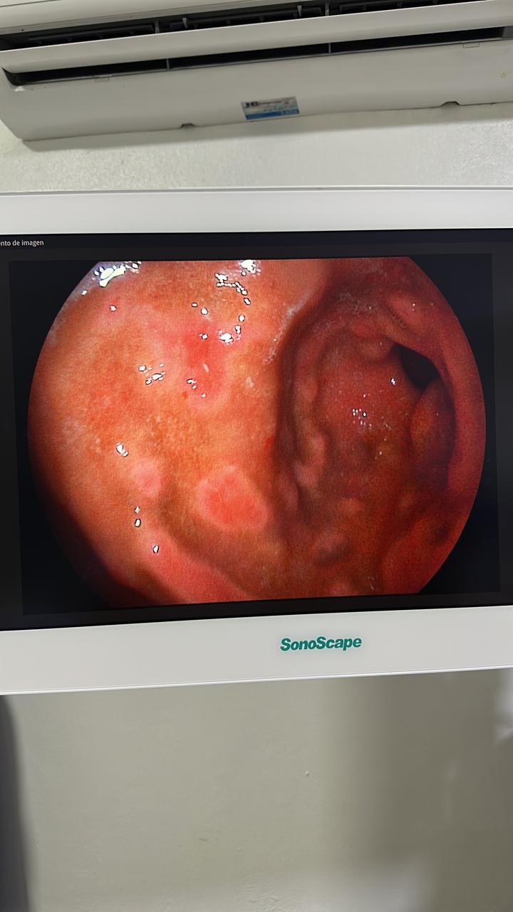 Gastric Nodular Changes On Endoscopy