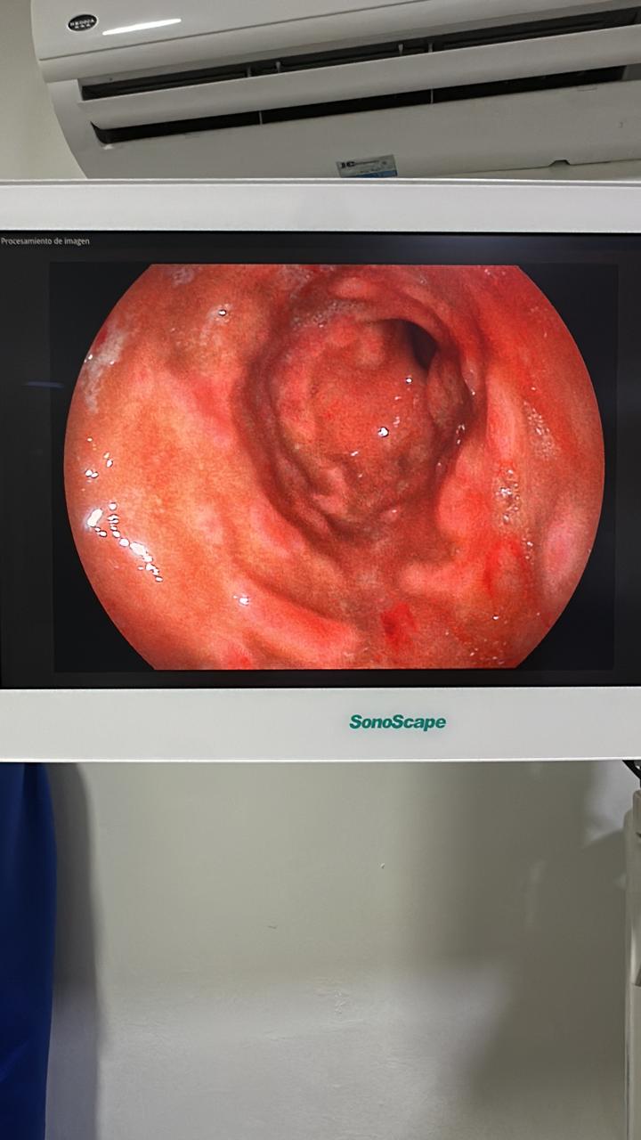 Additional Gastric Endoscopic View