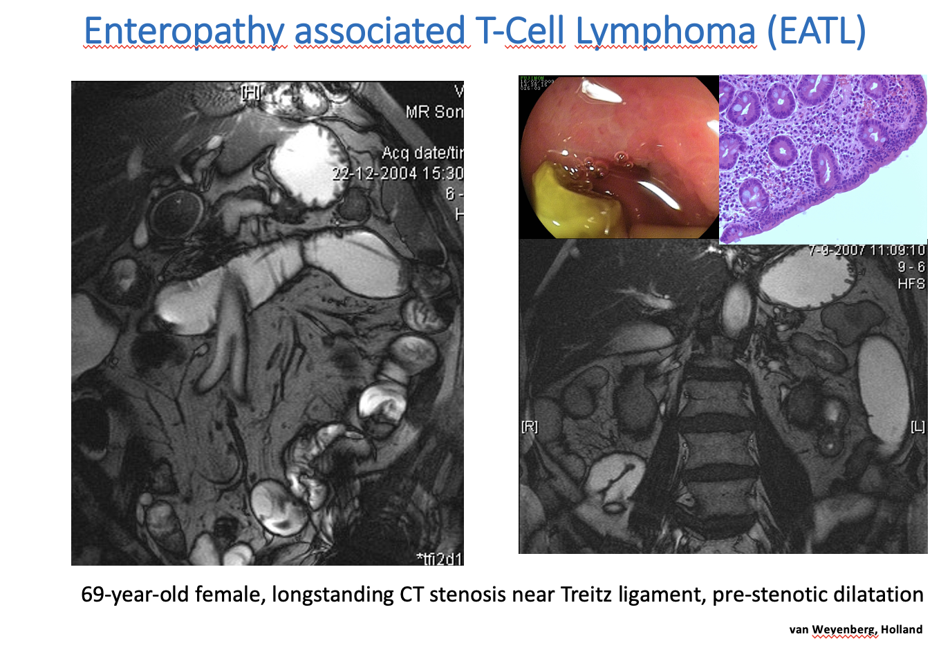 Composite Teaching Slide For Enteropathy-Associated T-Cell Lymphoma With Mr Enterography, Endoscopic, And Histology Panels.