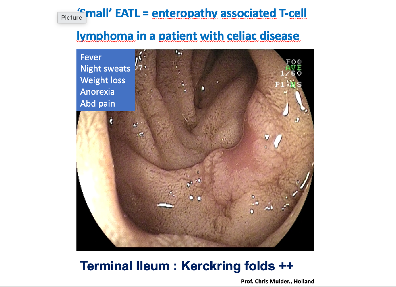 Endoscopic Teaching Slide Showing Prominent Kerckring Folds In The Terminal Ileum In Enteropathy-Associated T-Cell Lymphoma.