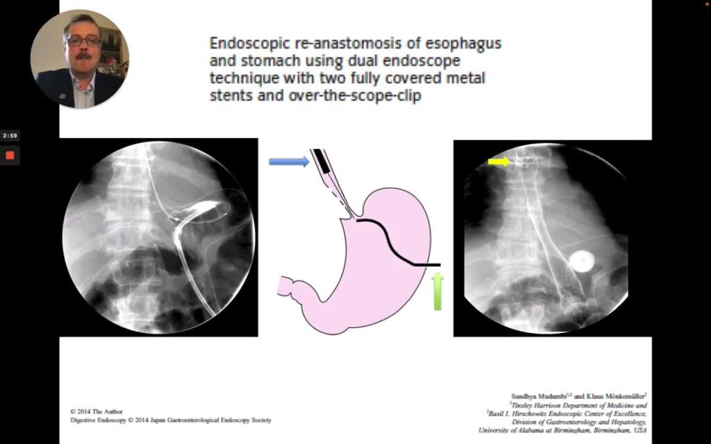 Endoscopic View Of Esophageal Dehiscence Following Stent Migration And Perforation