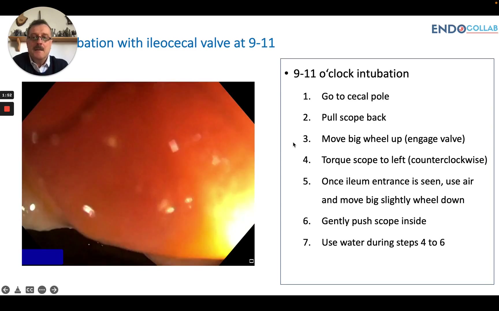 Scope Torque And Water Flush Techniques For The 9 O&Amp;Apos;Clock Ileocecal Valve Intubation