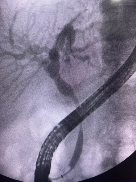 Figure 2. Ercp After Balloon Sweeping. Balloon Sweep Of The Bile Duct. The Distal Radiopaque Structure Corresponds To The Extraction Balloon, Not A Retained Common Bile Duct Stone.