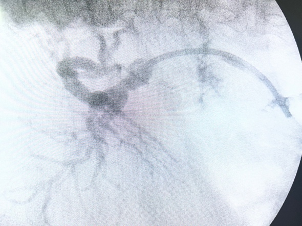 Figure 3. Final Ercp Image. Transpapillary Biliary Stent In Adequate Position, Securing Internal Biliary Drainage.