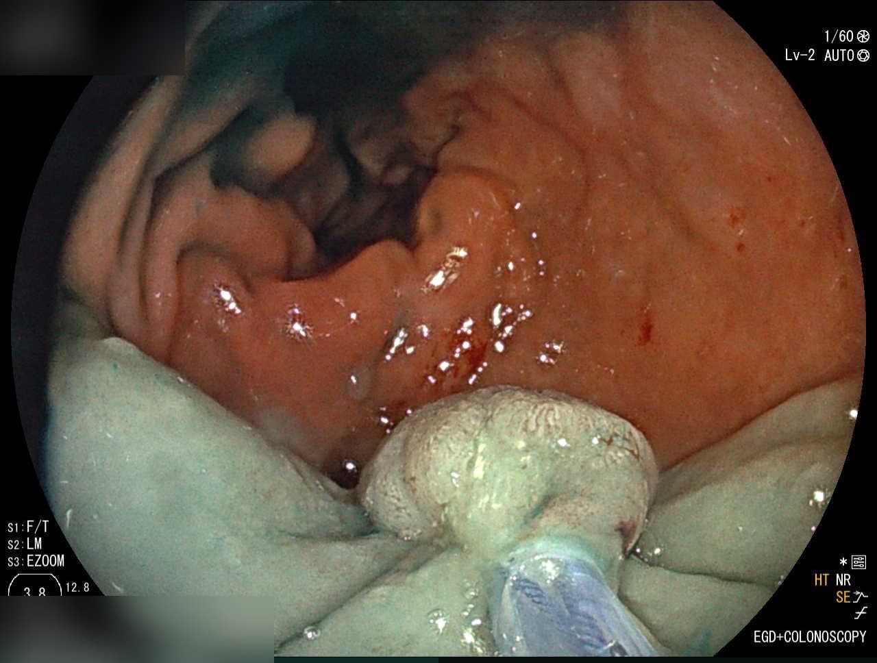Post-Emr Scar With Residual Specimen Being Removed