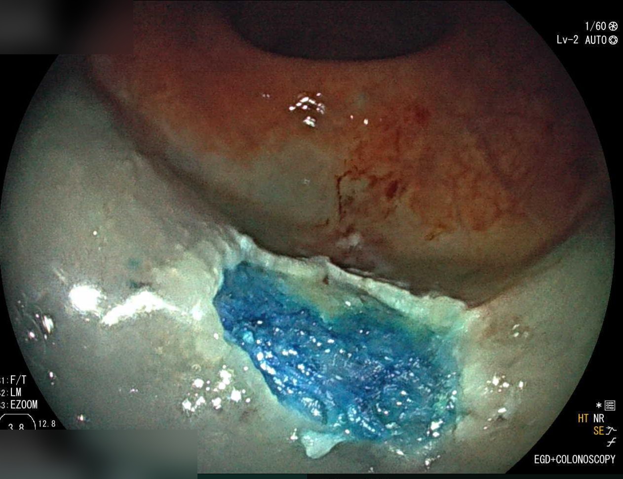 Post-Emr Resection Defect With Blue Dye Injection