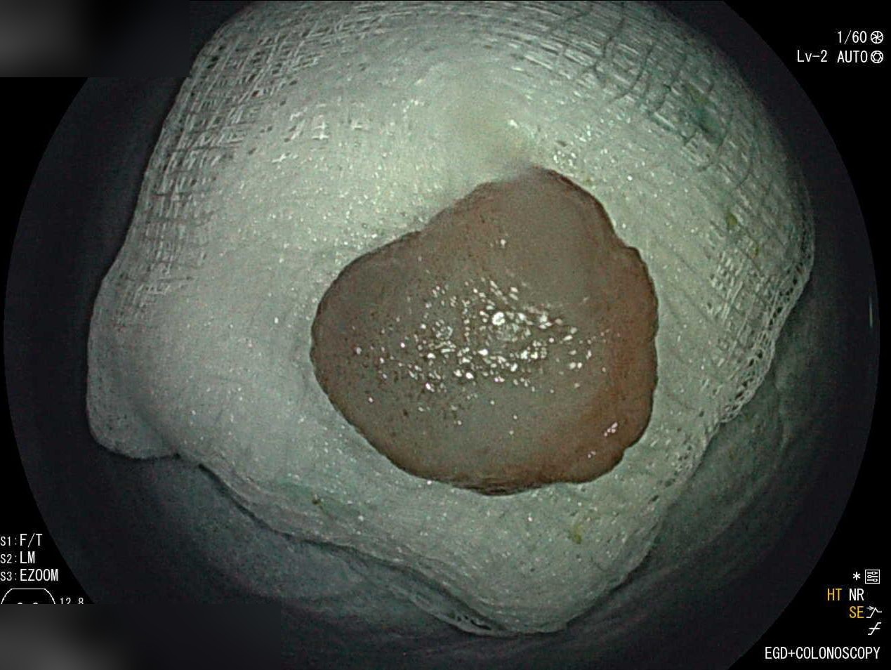 Post-Emr Rectal Defect Showing Clean Resection Margins
